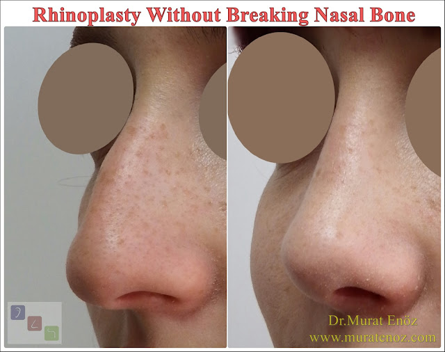 Why is this rhinoplasty without breaking the bone preferred? - A "perfect nose" or "more beautiful and natural looking nose" ... - Which patients are eligible for rhinoplasty without breaking the bone? - Can rhinoplasty without breaking the bone operation be performed under local anesthesia? - Cost of rhinoplasty without breaking the bone in Istanbul - Advantages rhinoplasty without breaking the bone over the classical rhinoplasty operation - Disadvantages rhinoplasty operation without breaking the bone - Before and After Photos For Rhinoplasty Operation Without Breaking The Nasal Bone