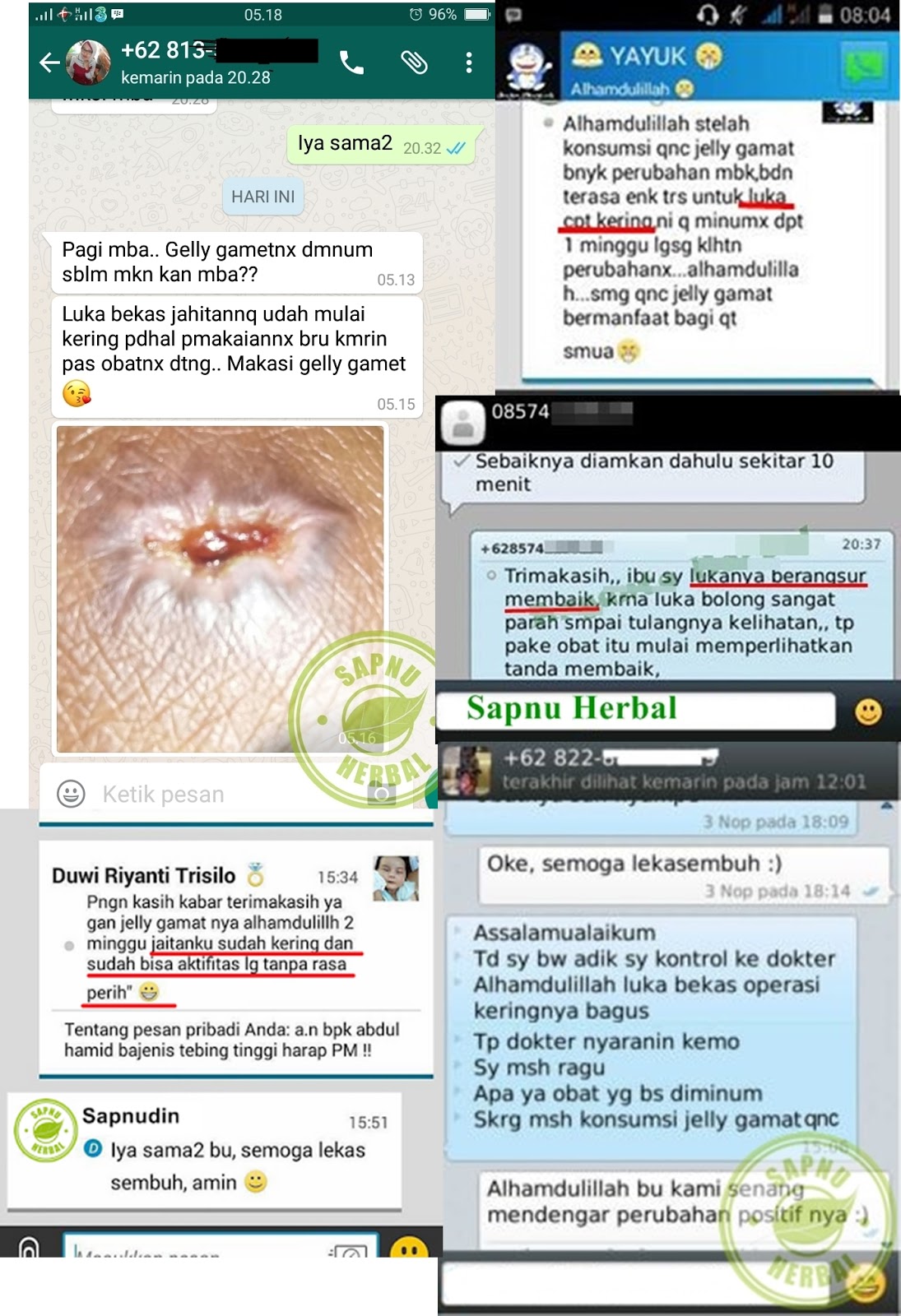 Cara Mengobati Luka Luar Agar Cepat Kering Dan Sembuh Obat Herbal Terbaik
