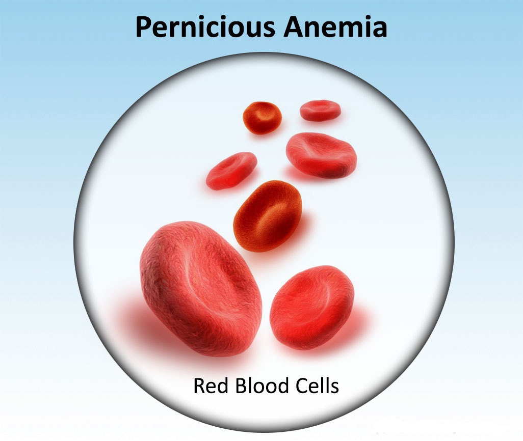 My Family Medicine Practice Introduction To Pernicious Anemia