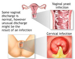 Apa Obat Tradisional alami Untuk penyakit Kencing Nanah