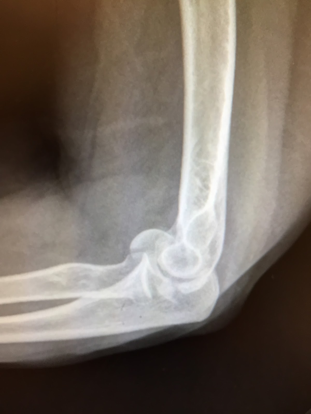 Shoulder and Elbow Surgery Shear fractures of the capitellum.