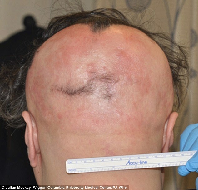 صورة لرأس مريض قبل العلاج