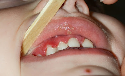 Điều trị viêm chân răng ở trẻ như thế nào?