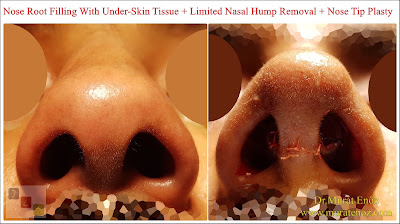 Rhinoplasty without breaking the bone in Istanbul - Nose job without bone broken Turkey - Nose tip plasty in Istanbul - Nasal hump removal Istanbul - Nose job without breaking the bone in Turkey - Nose tip lifting Istanbul