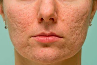 acne scar removal treatment