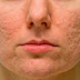 Acne Scar Removal Treatment