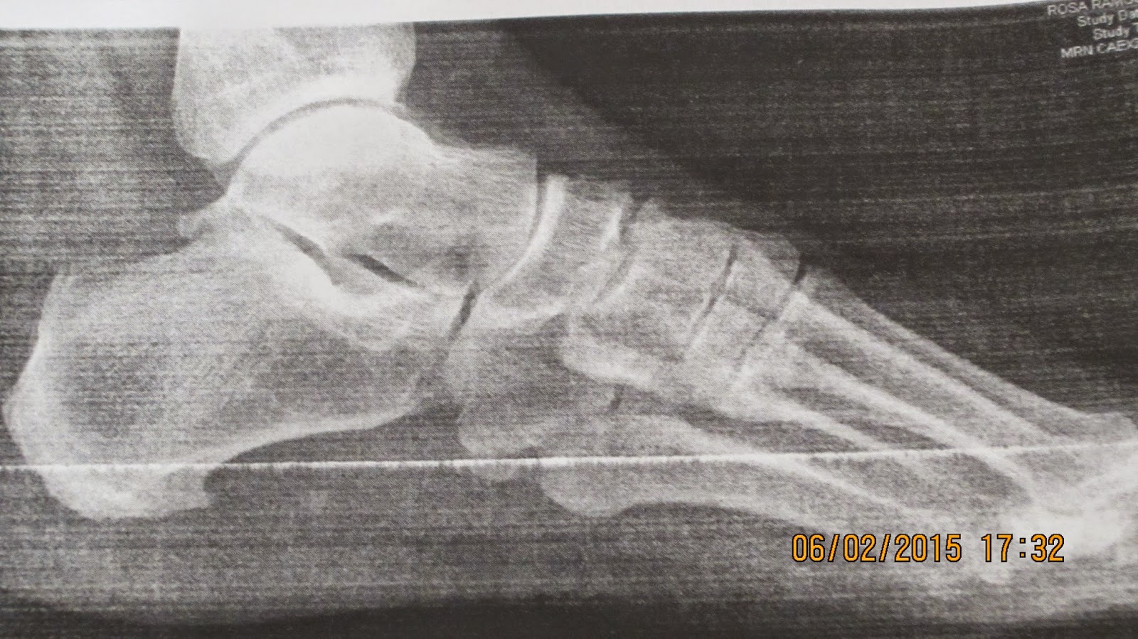 Body Art Siruela siruela .Pie plano,pie