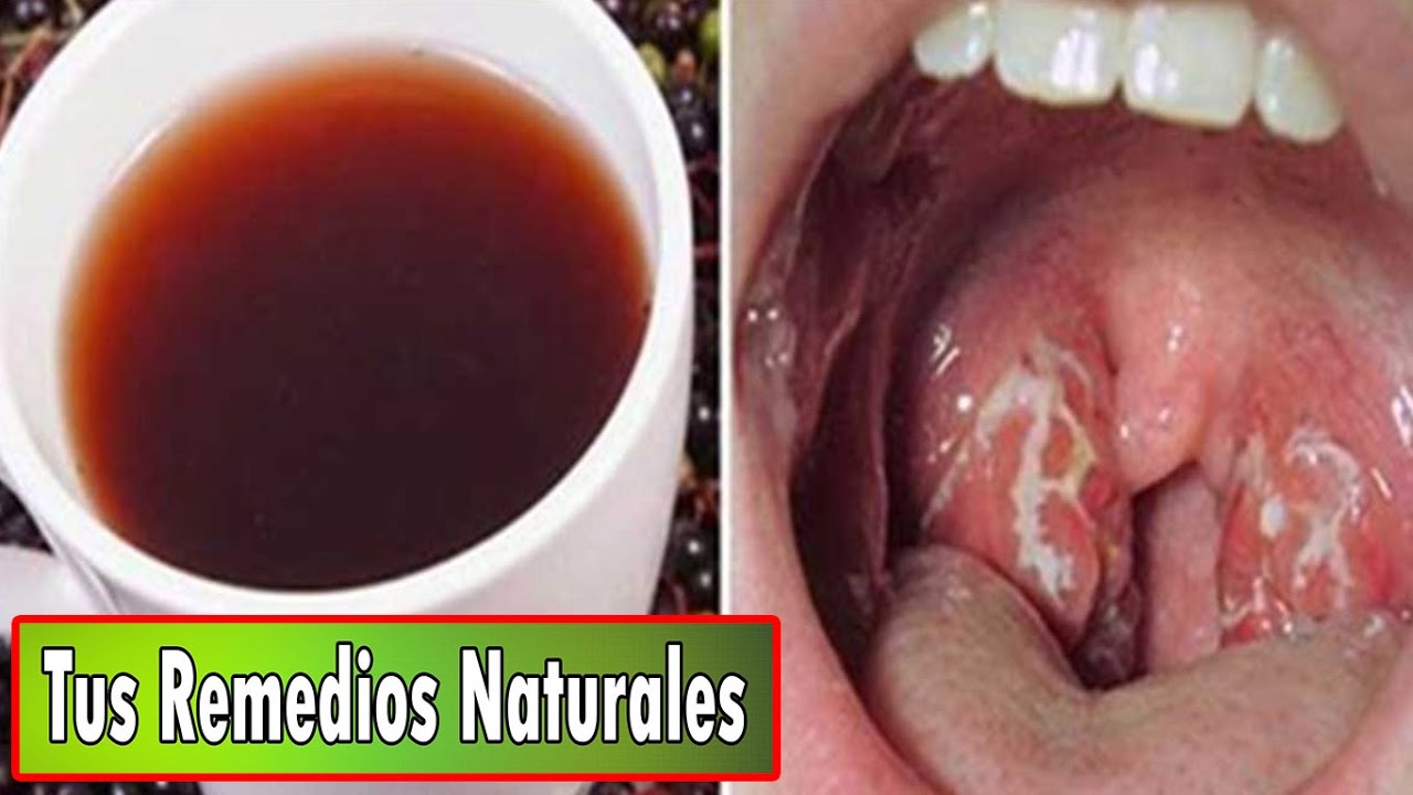 Buena Vida Como Deshacerse de la Infección de Garganta de Forma Natural en Solo 4 Horas Compártelo Buena Vida Como Deshacerse de la Infección de Garganta de Forma Natural en Solo 4 Horas Compártelo