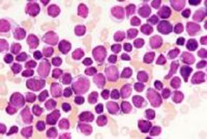 Gambaran sumsum tulang pada Leukemia Limfoblastik Akut