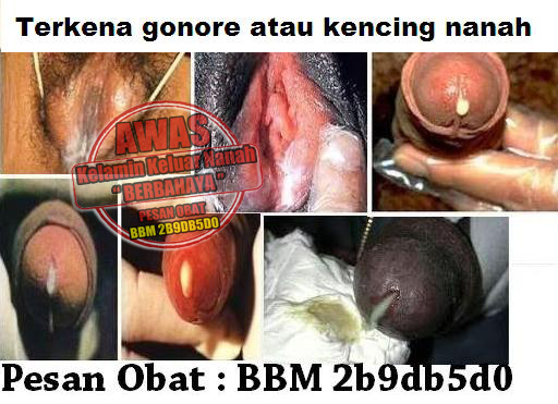Toko Pengobatan De Nature Untuk Penyakit Gonore (Kencing Nanah) Toko Pengobatan De Nature Untuk Penyakit Gonore (Kencing Nanah)