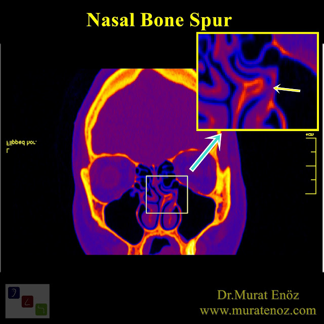 Nasal Bone Spur Formation - Atypical Headache - Nose Bone Spur - Bone Spur Formation of The Nose Definition - Symptoms of The Nasal Bone Spur Formation - Treatment of The Nasal Bone Spur Formation