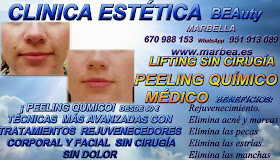 MARBELLA PEELING FACIAL QUIMICO MARBELLA PEELING FACIAL QUIMICO MEDICO PARA ELIMINACIÓN , QUITAR , TRATAMIENTO: ACNÉ , MARCAS , CICATRICES , MANCHAS ,PECAS , ESTRÍAS , MANCHAS