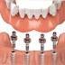 Kỹ thuật trồng răng implant hiệu quả