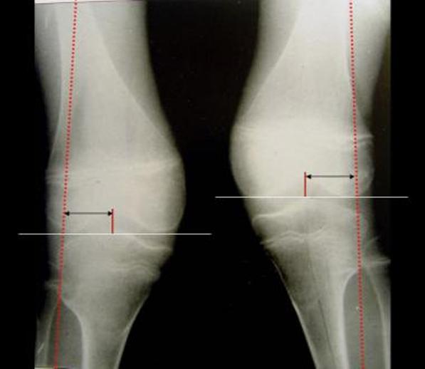 Knock Knees or Genu Valgum Health And Medical Information