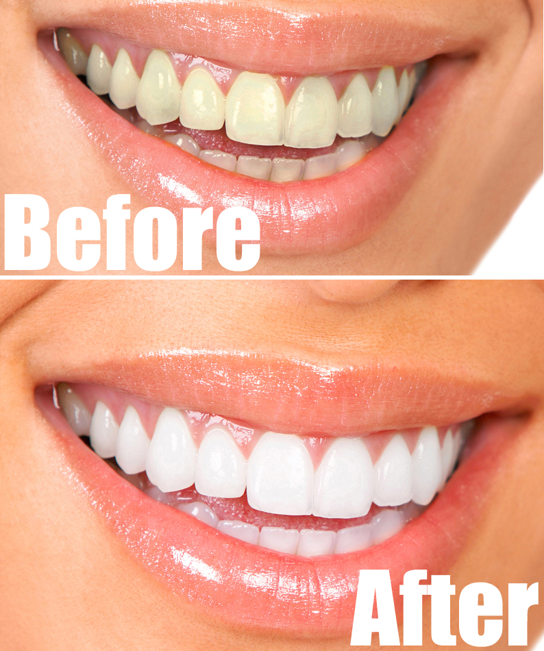 List of 5 natural home remedies for teeth whitening