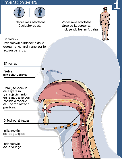 Que es faringitis y laringitis