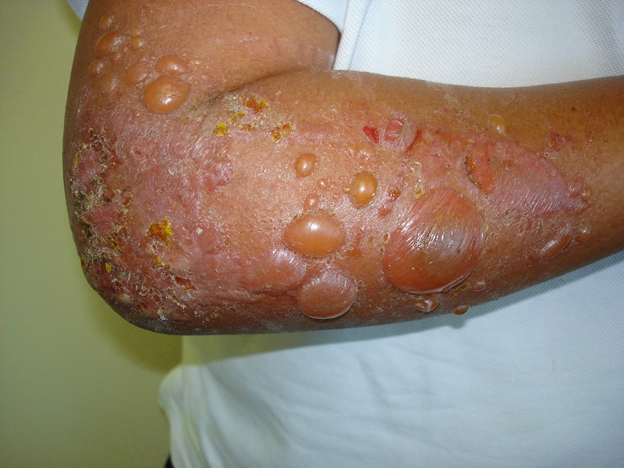 spongiotic dermatitis คือ treatment