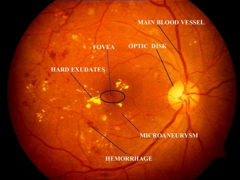 detached retina symptoms blood detached retina symptoms blood