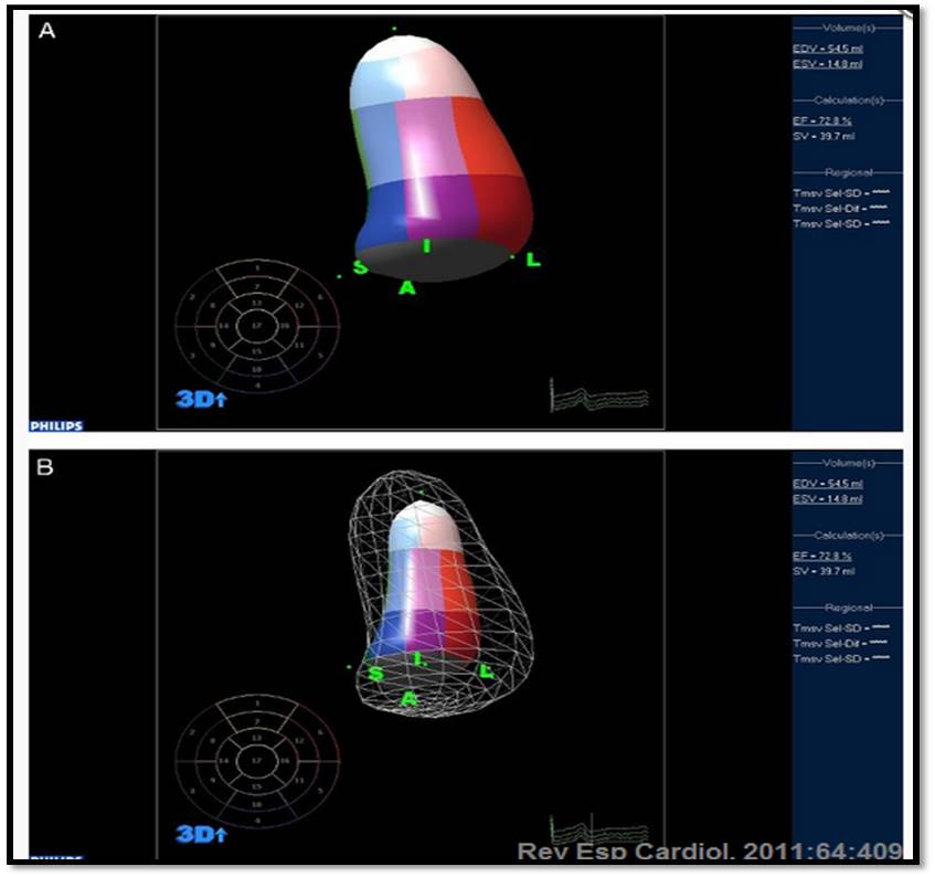 Hipertensión inducida por miocardiopatía Hipertensión inducida por miocardiopatía