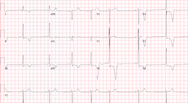 Неспецифическое нарушение т на экг что. Смотреть фото Неспецифическое нарушение т на экг что. Смотреть картинку Неспецифическое нарушение т на экг что. Картинка про Неспецифическое нарушение т на экг что. Фото Неспецифическое нарушение т на экг что Неспецифическое нарушение т на экг что. Смотреть фото Неспецифическое нарушение т на экг что. Смотреть картинку Неспецифическое нарушение т на экг что. Картинка про Неспецифическое нарушение т на экг что. Фото Неспецифическое нарушение т на экг что