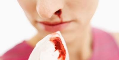 Penyebab Hidung Berdarah