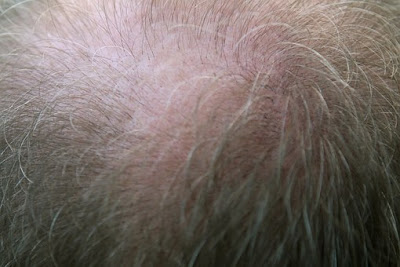 HAIR LOSS AND IT CAUSES IN WOMEN, HAIR LOSS, hair loss in women