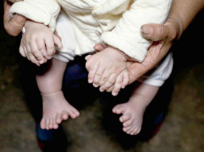PICShock as Baby is BORN with 31 fingers and toes!