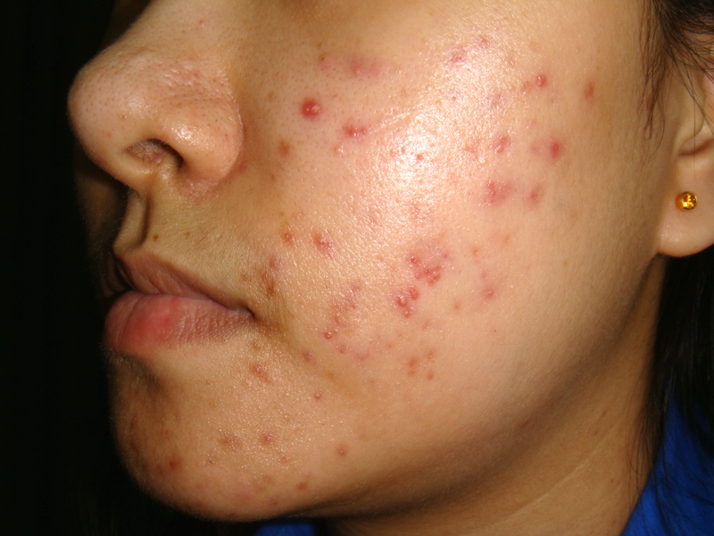 10 most powerful ways to get rid of acne naturally and quickly All