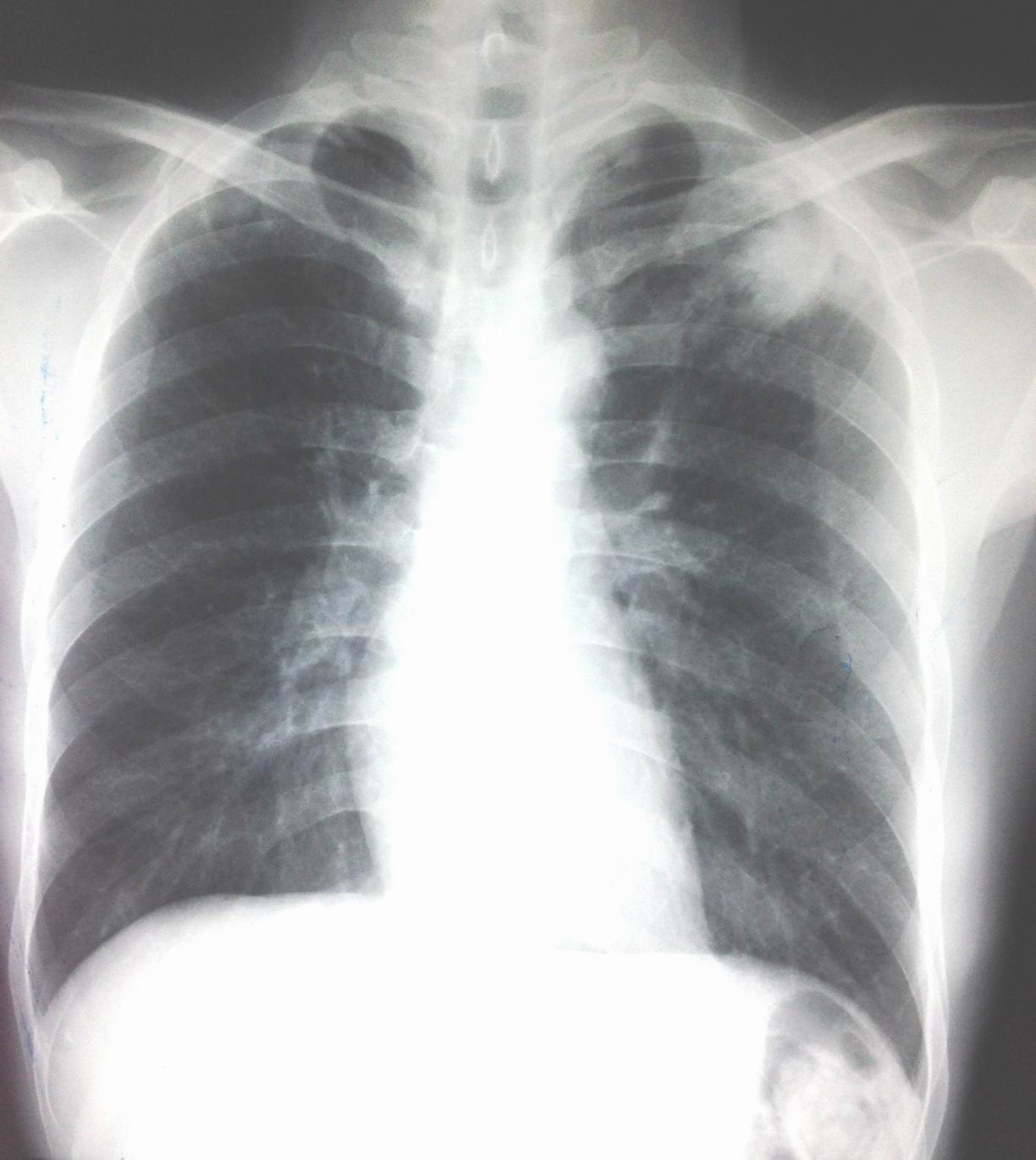 Rectal Cancer Home Remedies Chest X Ray Colon Cancer