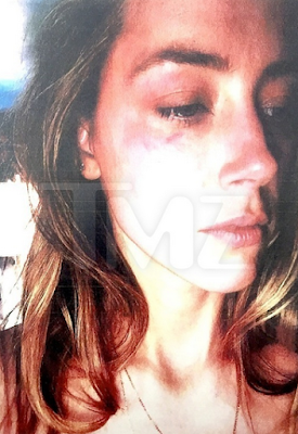 Amber Heard files for restraining order against Johnny Depp, claims physical assault (photos of her alleged injury)