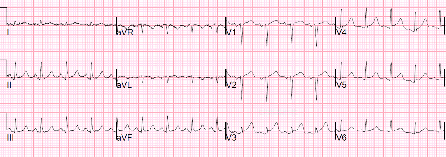 Dr. Smith's ECG Blog COPD exacerbation, what do the ECG and bedside
