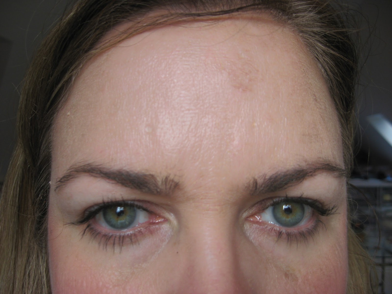 My TCA Facial Peel Experience | Ages of Beauty: My TCA Facial Peel ...