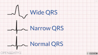 Kompleks QRS