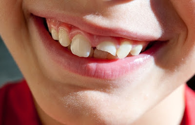 Bị vỡ răng không hàn có ảnh hưởng gì không?