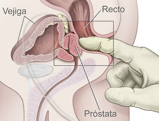 Problemas de prostata