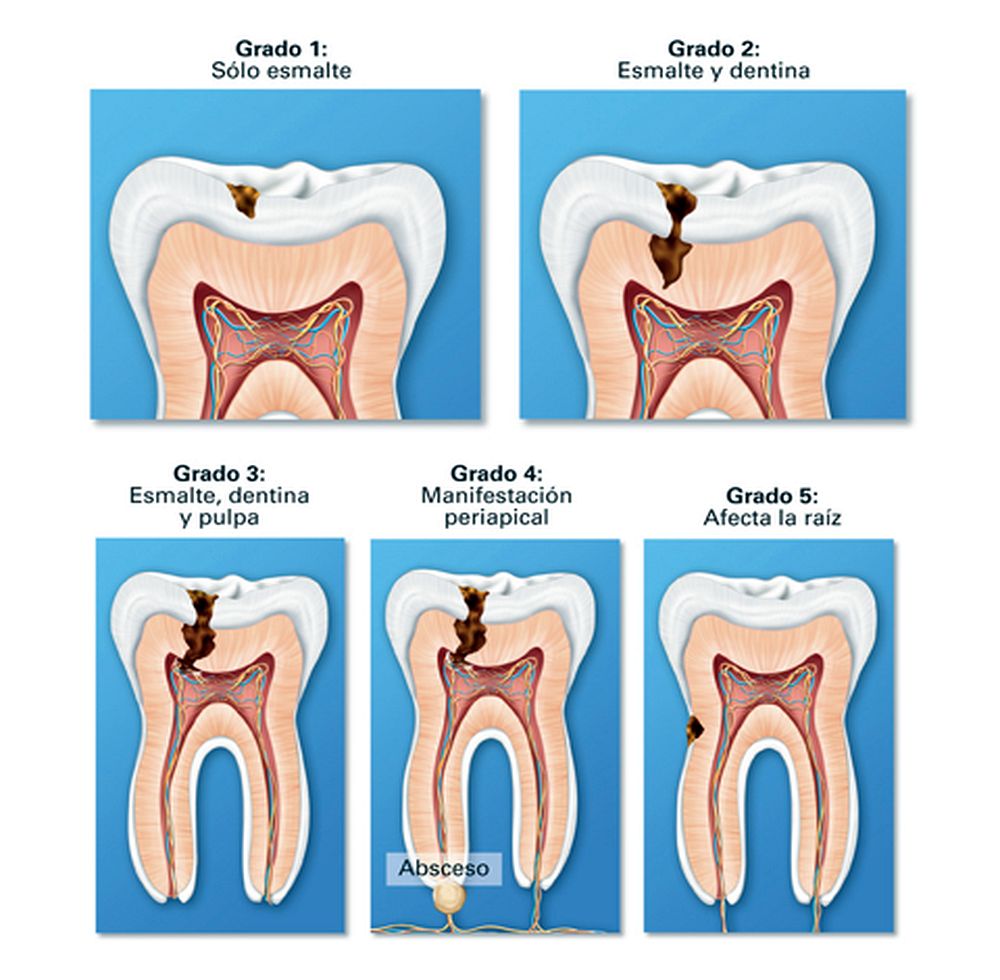CARIES DENTAL Conozca los síntomas y tratamientos para curarlas Directorio Odontológico CARIES DENTAL Conozca los síntomas y tratamientos para curarlas Directorio Odontológico