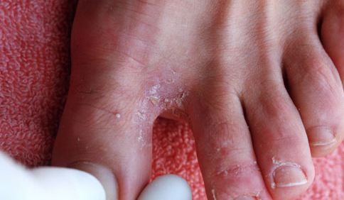 Perfect Athlete's Foot Treatment, Causes &amp; Symptoms - NikiHow