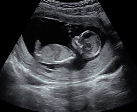 amac hak sahibi marka 14 haftalik erkek bebek ultrason resmi sudecicekcilik net