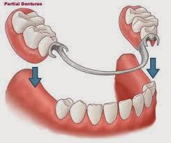 http://www.dentistinchennai.com/removable-denture.php