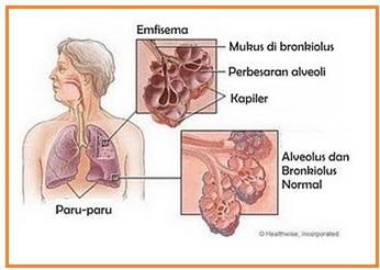 Terjadinya pembengkakan pada paru-paru karena pembuluh darah pada paru-paru kemasukan udara merupakan bentuk dari penyakit pada sistem pernapasan yang dikenal dengan