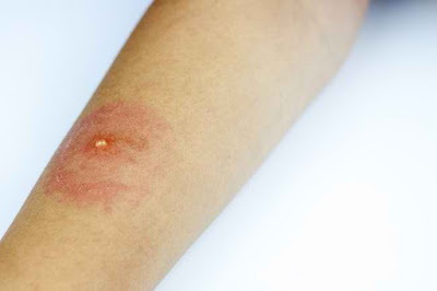 Ahlinya Obat Gatal Ahlinya Obat Gatal
