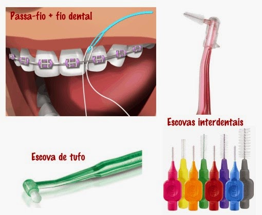 Clinica Dentaria Mais Sorriso: Como escovar os dentes usando aparelho