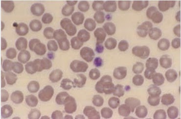 Platelet Disorders | Tuyenlab