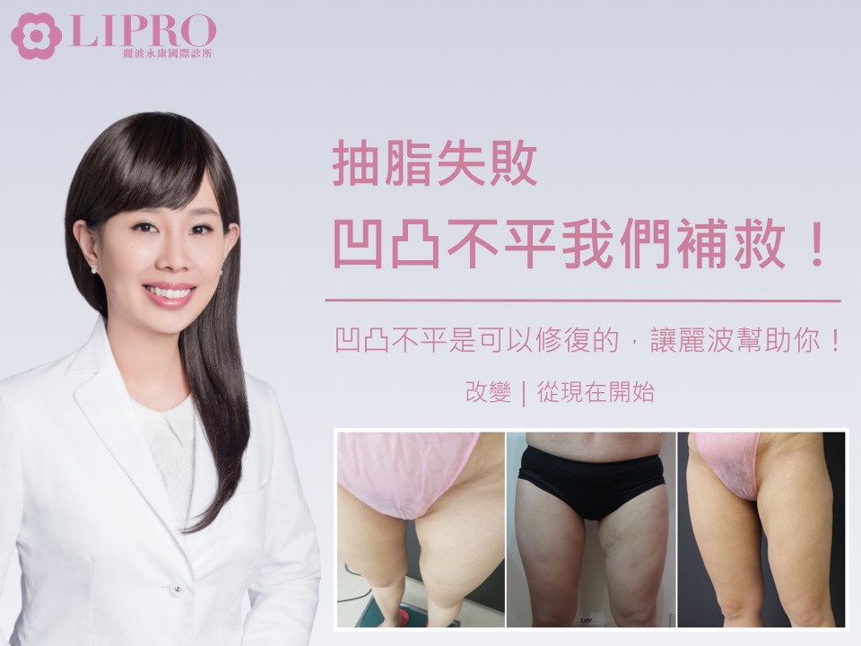 抽脂凹凸不平 抽脂凹凸不平怎麼補救 抽脂後遺症 抽脂失敗 抽脂恢復期 抽脂凹凸不平 抽脂凹凸不平怎麼補救 抽脂後遺症 抽脂失敗 抽脂恢復期