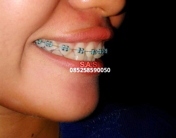 Top Info Karet Behel Warna Putih Bening, Ide Terbaru!