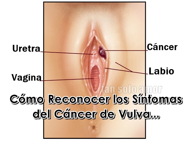 vulva cancer image