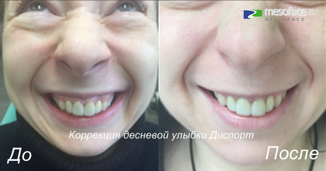 До и после пластики уздечки Удаление уздечки верхней губы лазером до и после - TouristMaps.ru