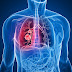 Warning Signs of Mesothelioma
