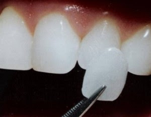 Hàn khe răng thưa có độ bền bao lâu?