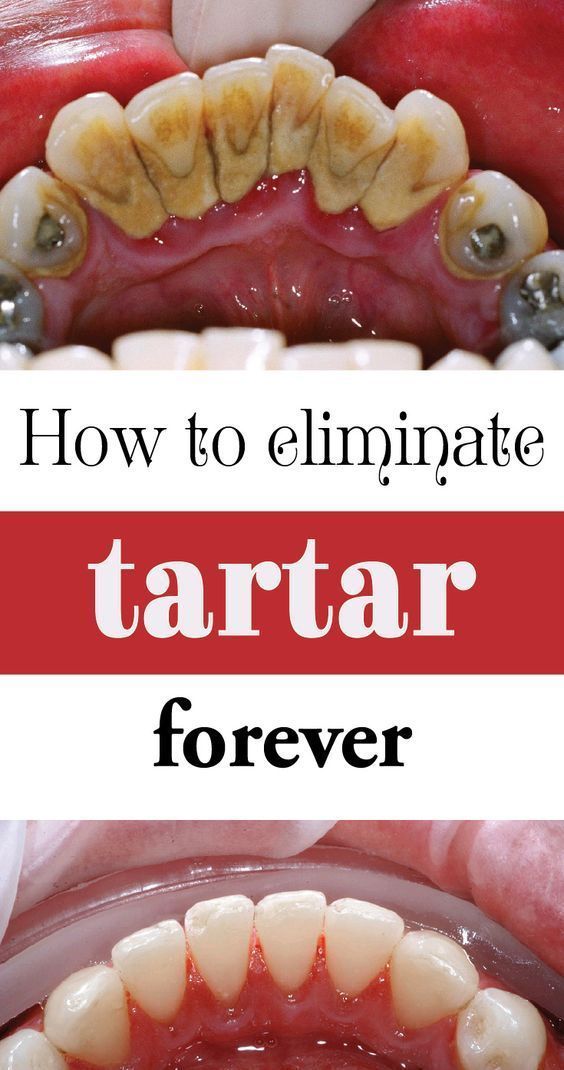 10 EFFECTIVE TRICKS TO REMOVE PLAQUE AND TARTAR – BE YOUR OWN DENTIST